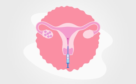Embryo Transfer in IVF: A Comprehensive Guide