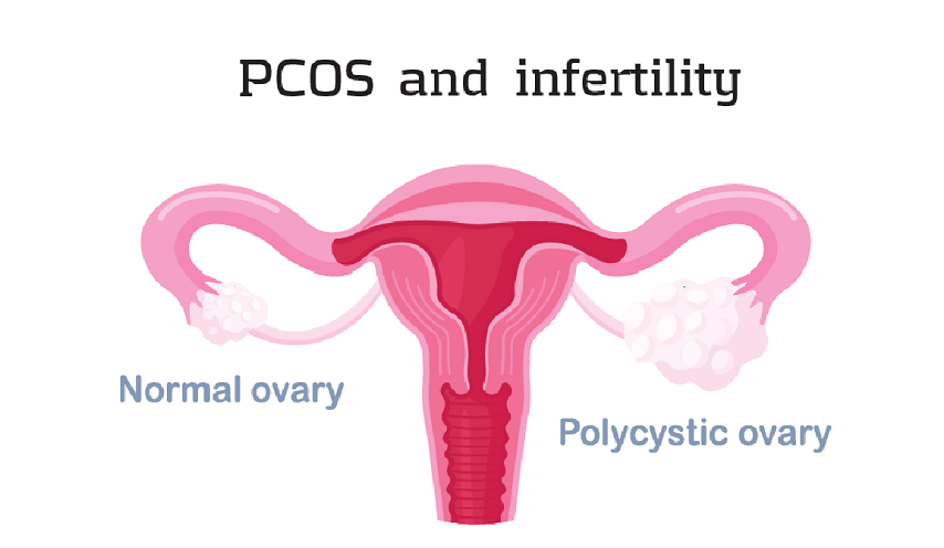 Fertility and PCOS